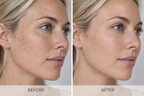 Before and after comparison showing the appearance of facial pigmentation and uneven skin tone following skincare treatment.
