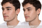 Side-by-side before and after facial photographs of a man showing changes in skin appearance, featured with DP Dermaceuticals CLR Lotion.