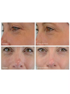 Medik8 Crystal Retinal 10 before and after 12 weeks comparison showing the appearance of fine lines and wrinkles around the eyes.