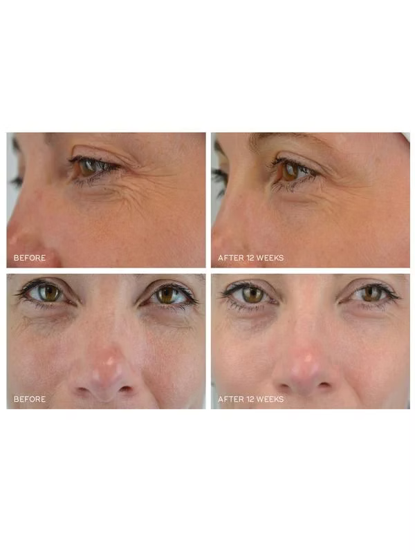 Medik8 Crystal Retinal 10 before and after 12 weeks comparison showing the appearance of fine lines and wrinkles around the eyes.