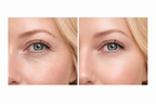 Side-by-side close-up comparison photographs of the under-eye area