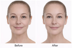 Before and after facial comparison showing visibly smoother fine lines around the eyes and a refreshed, more youthful-looking eye area in a Medik8 Advanced Night Eye 15ml promotional image.