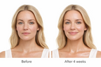 Side-by-side before-and-after facial photographs showing skin appearance