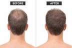 Before and after hair comparison showing a man's thinning crown and fuller-looking hair coverage in the after image, featured alongside DP EXO-GROW Scalp Mask.